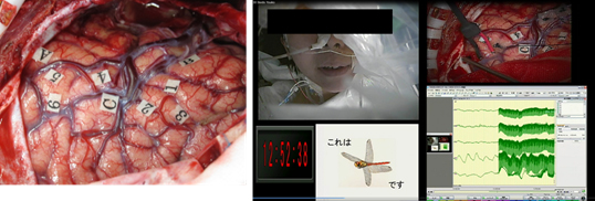焦点性てんかんに対する外科治療②－焦点切除術